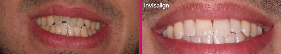 Invisalign Clínica Dental Paula Vila