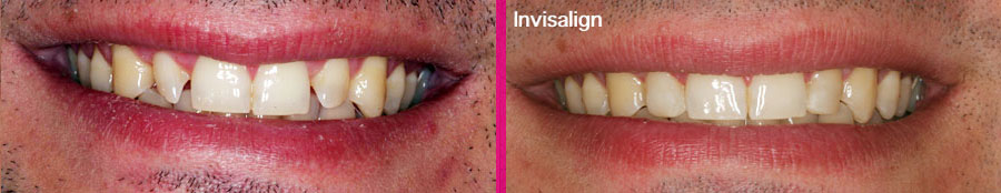 Invisalign Clínica Dental Paula Vila