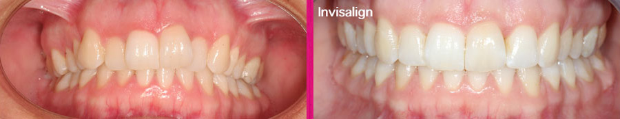 Invisalign Clínica Dental Paula Vila