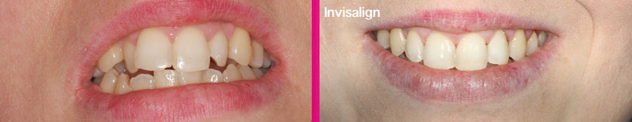 Invisalign Clínica Dental Paula Vila