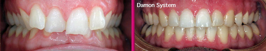 Invisalign Clínica Dental Paula Vila