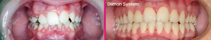 Invisalign Clínica Dental Paula Vila